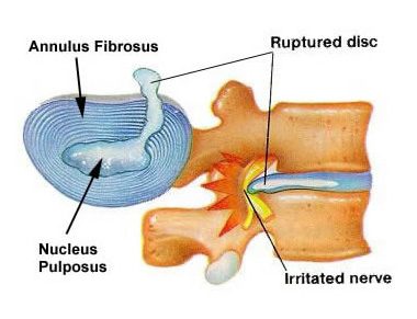 Diagram of a Disc prolapse