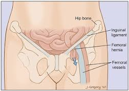 Inguinale en femorale hernia