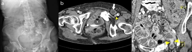 Inguinale hernia MRI