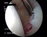 Labral damage in a shoulder joint