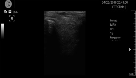 Musculoskeletal ultrasound