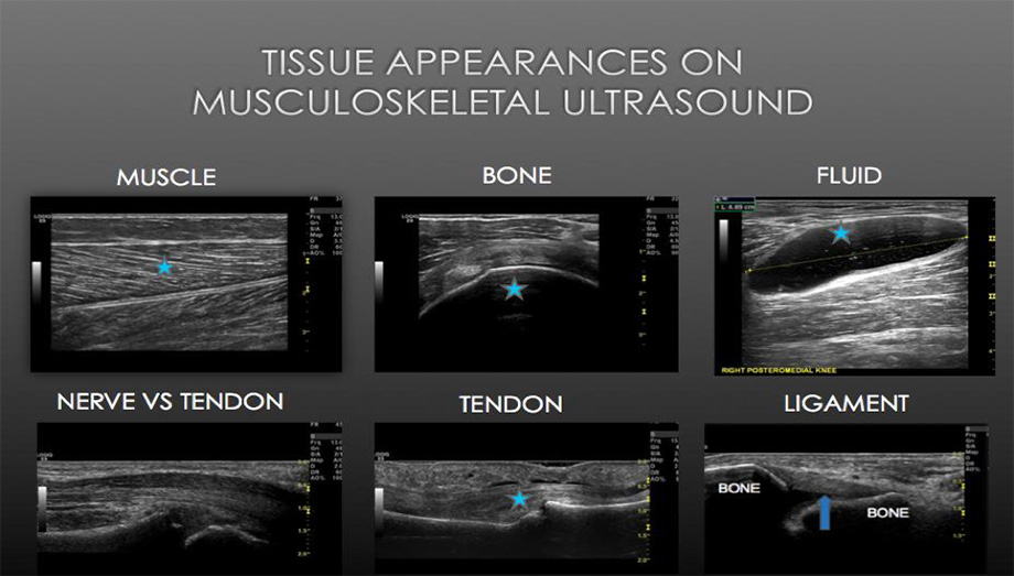 Musculoskeletal ultrasound