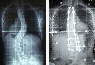 Scoliosis